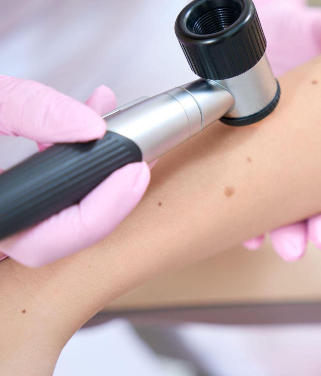 badanie-dermatoskopowe